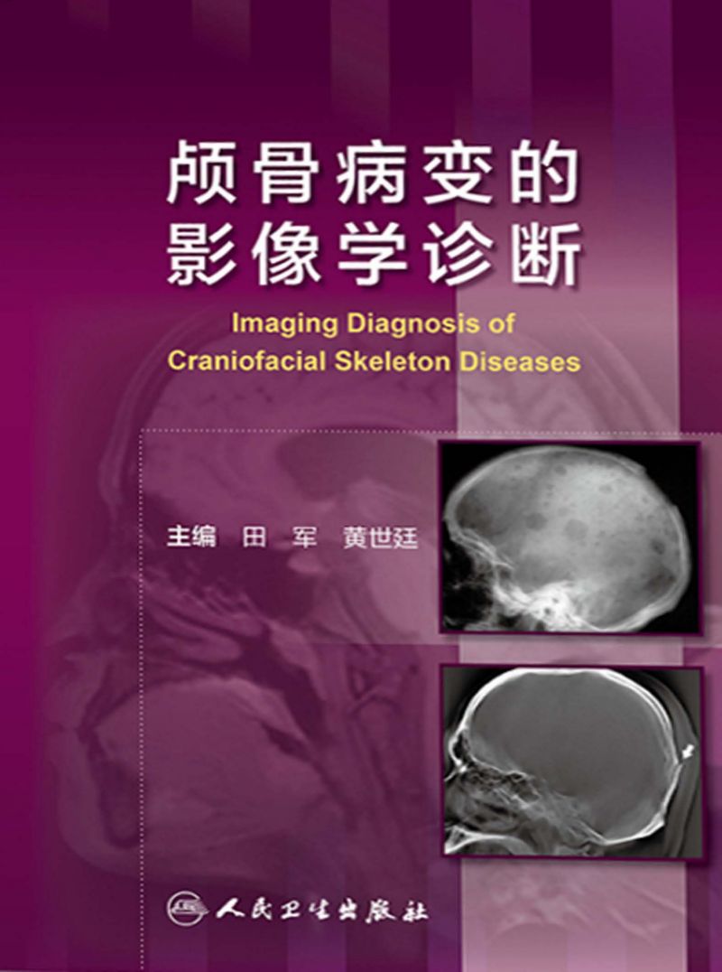 颅骨病变的影像学诊断