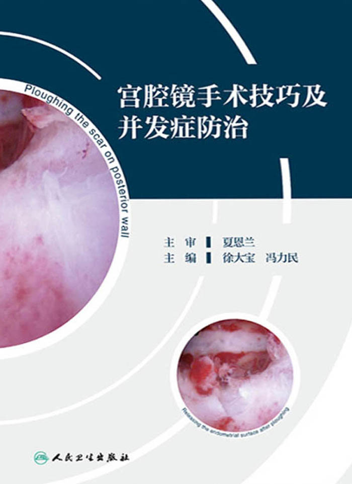 宫腔镜手术技巧及并发症防治