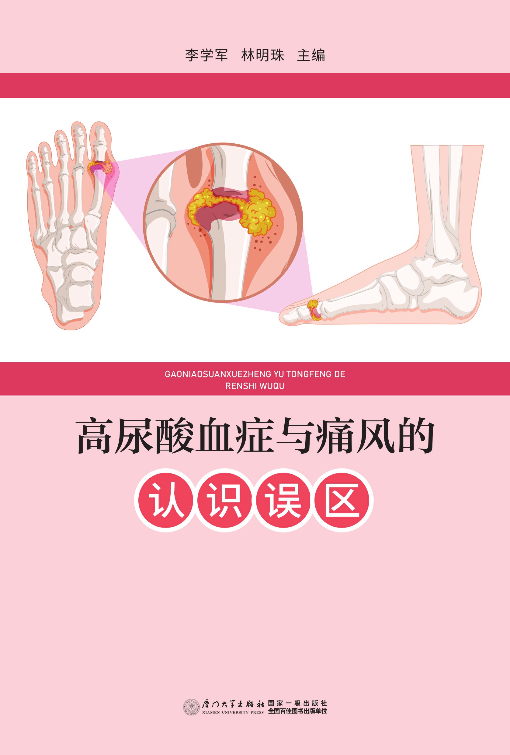 高尿酸血症与痛风的认识误区