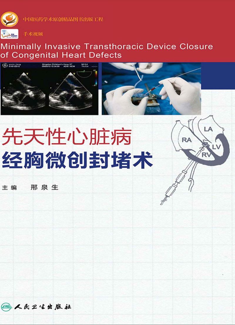 先天性心脏病经胸微创封堵术