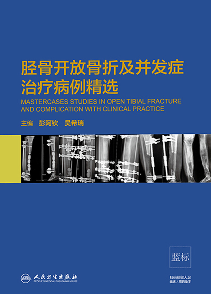 胫骨开放骨折及并发症治疗病例精选