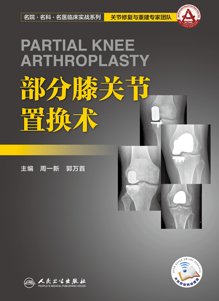 部分膝关节置换术
